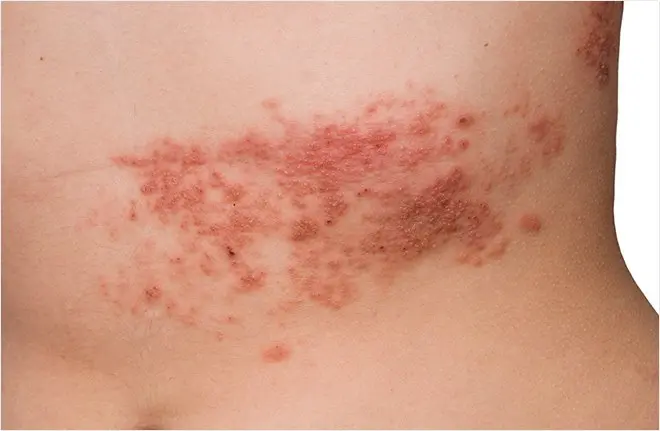 Post Herpetic Neuralgia