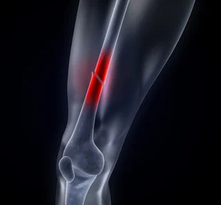 Growth Factor Therapy