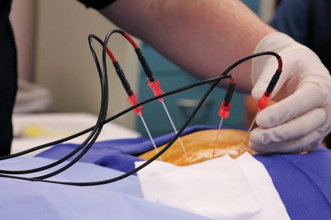 Radiofrequency Ablation (RFA)