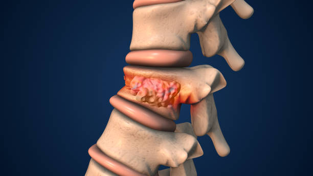 Vertebro Plasty